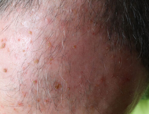 Understanding and Managing Actinic Keratosis